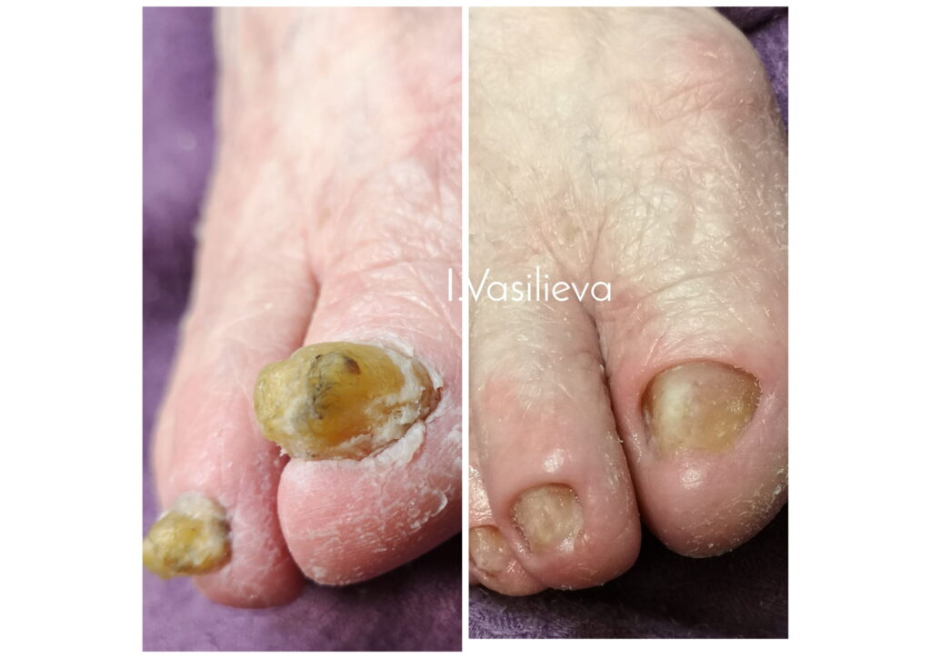 Результат лечения микоза ногтей