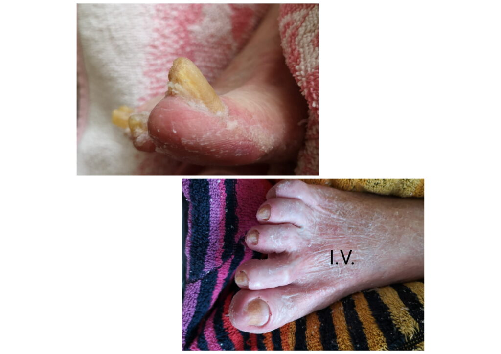 Результат лечения микоза ногтей