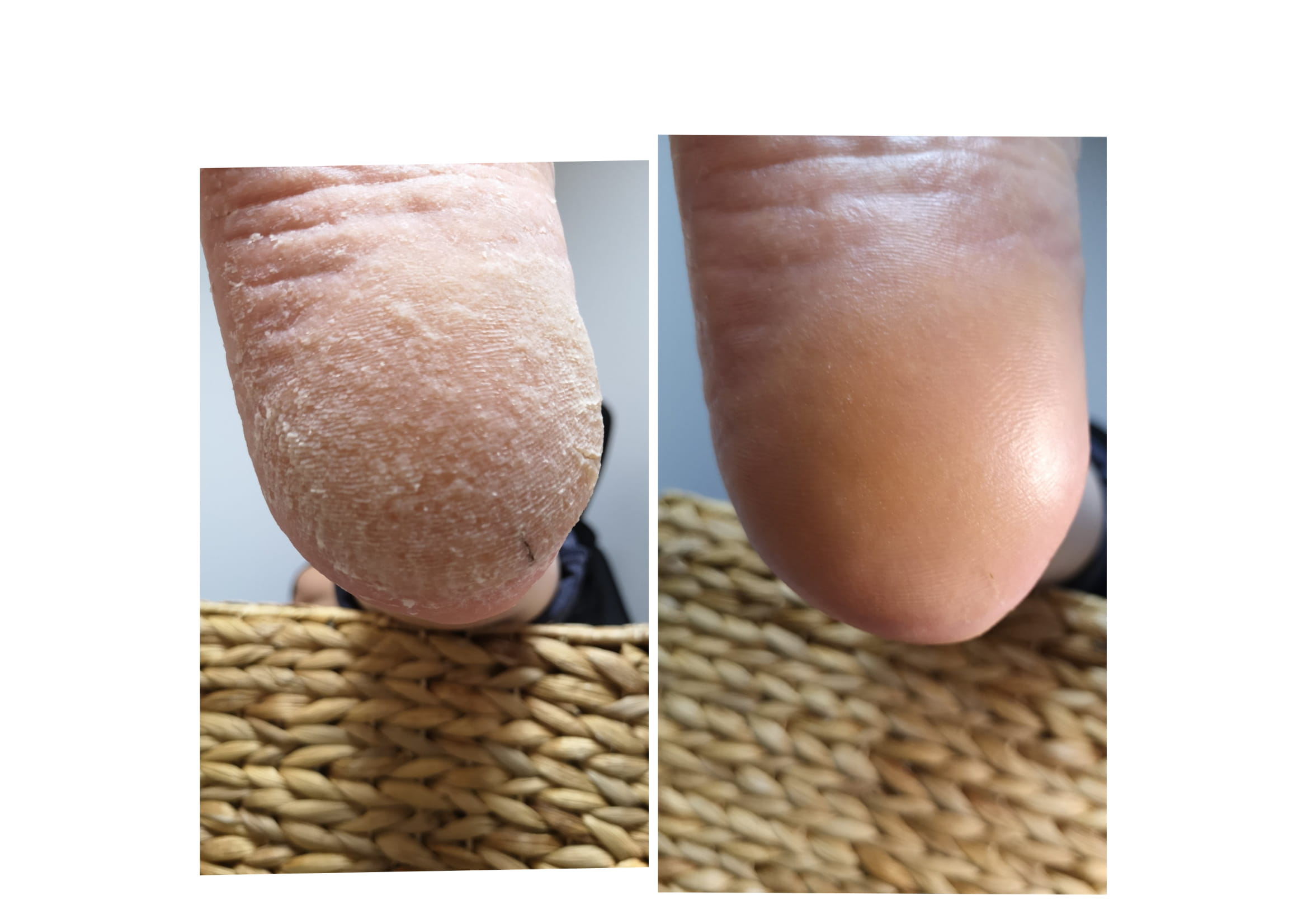 Лечение проблемного педикюра в Таллинне