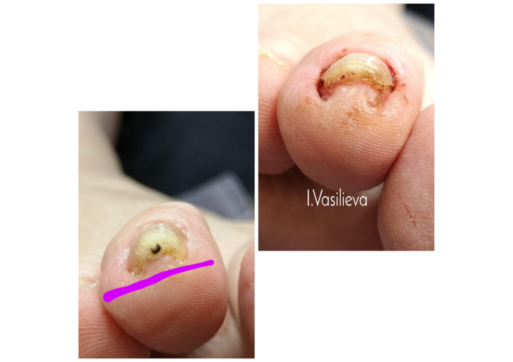 Результат лечения вросшего ногтя