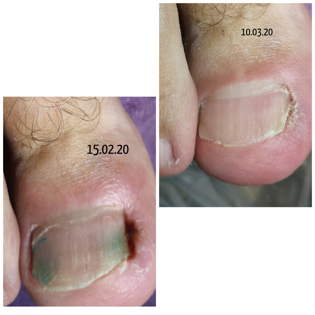 Результат лечения вросшего ногтя