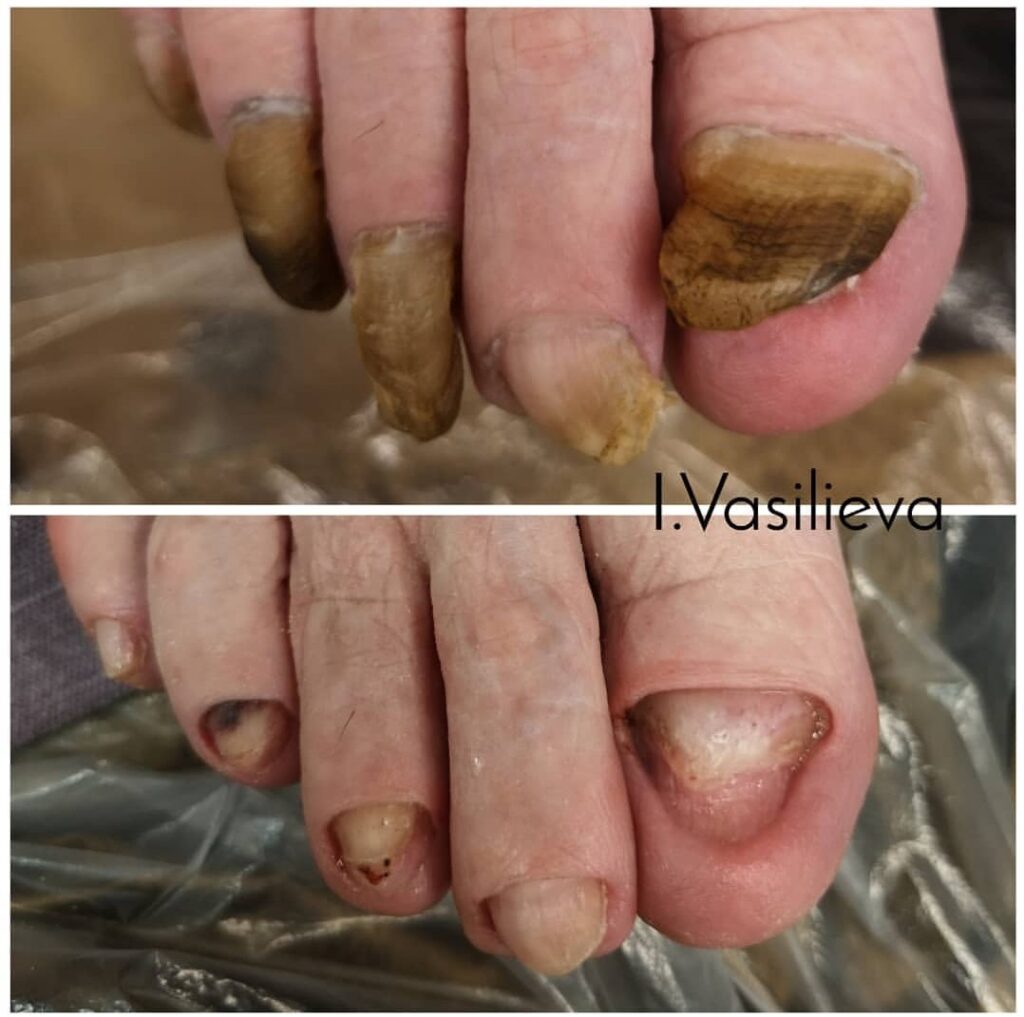 Лечение микоза ногтей в Таллинне