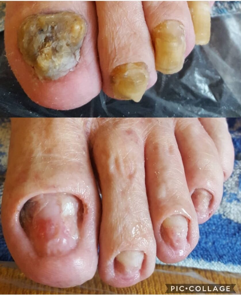 Лечение микоза ногтей в Нарве