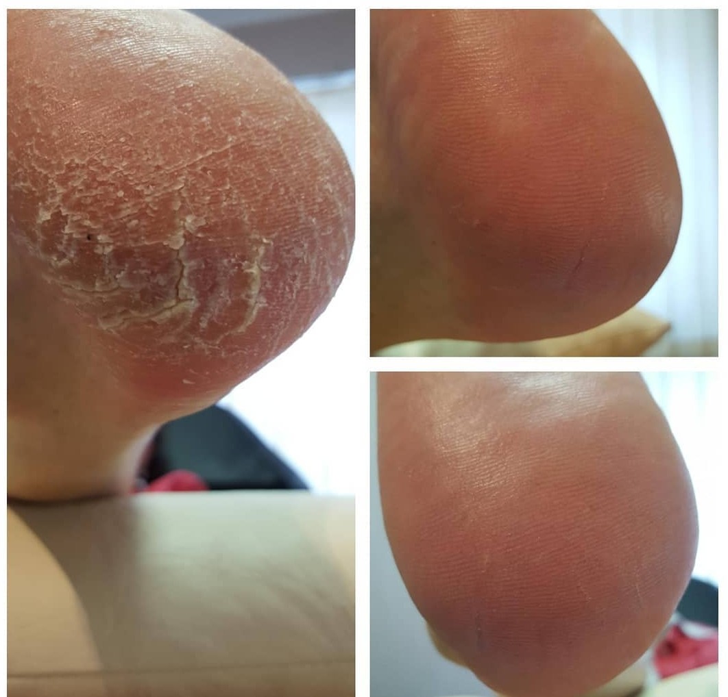 Лечение проблемного педикюра в Таллинне