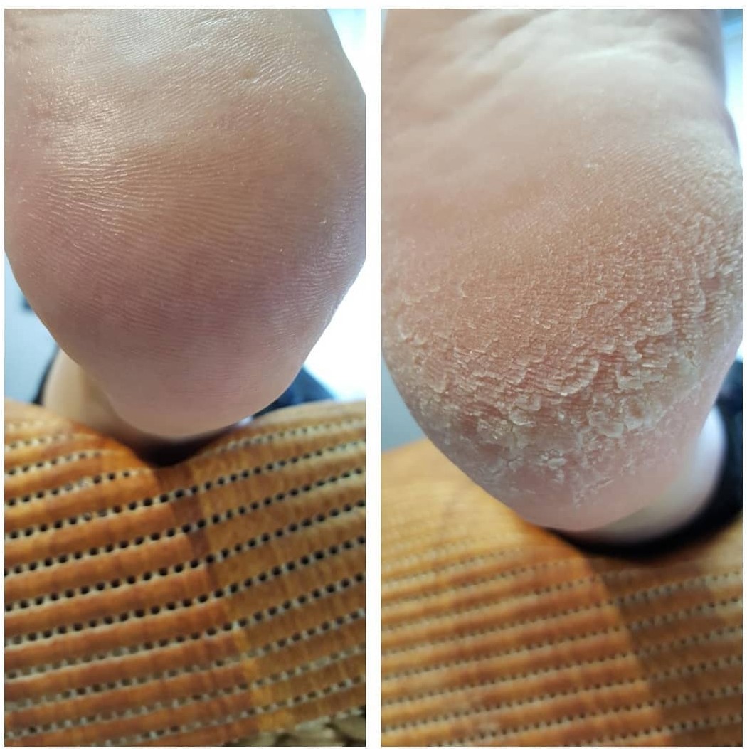 Probleemse pediküüri ja küünte ravi Tallinnas