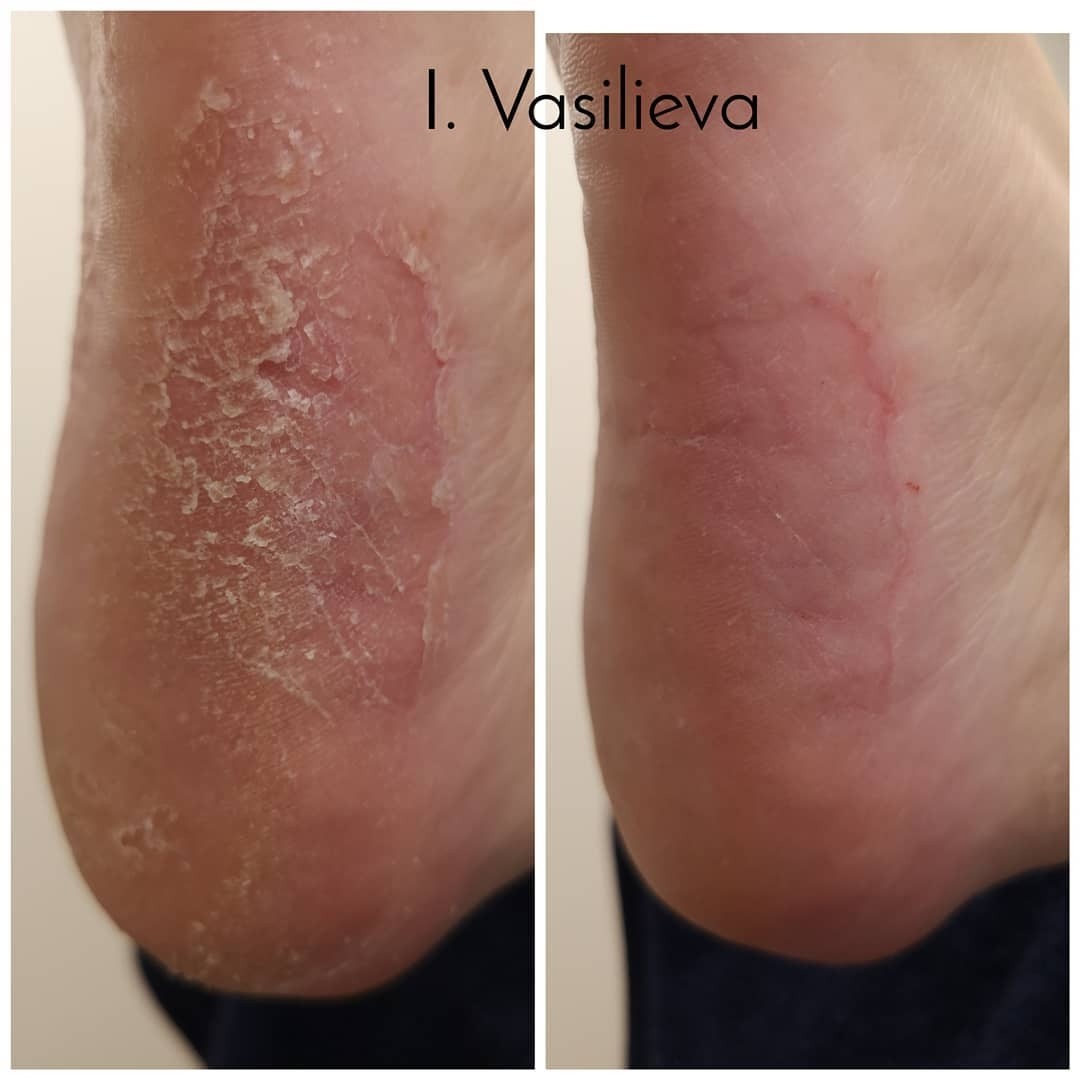 Лечение проблемного педикюра в Таллинне