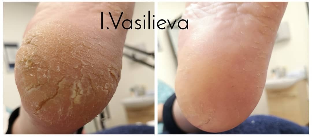 Лечение проблемного педикюра в Таллинне