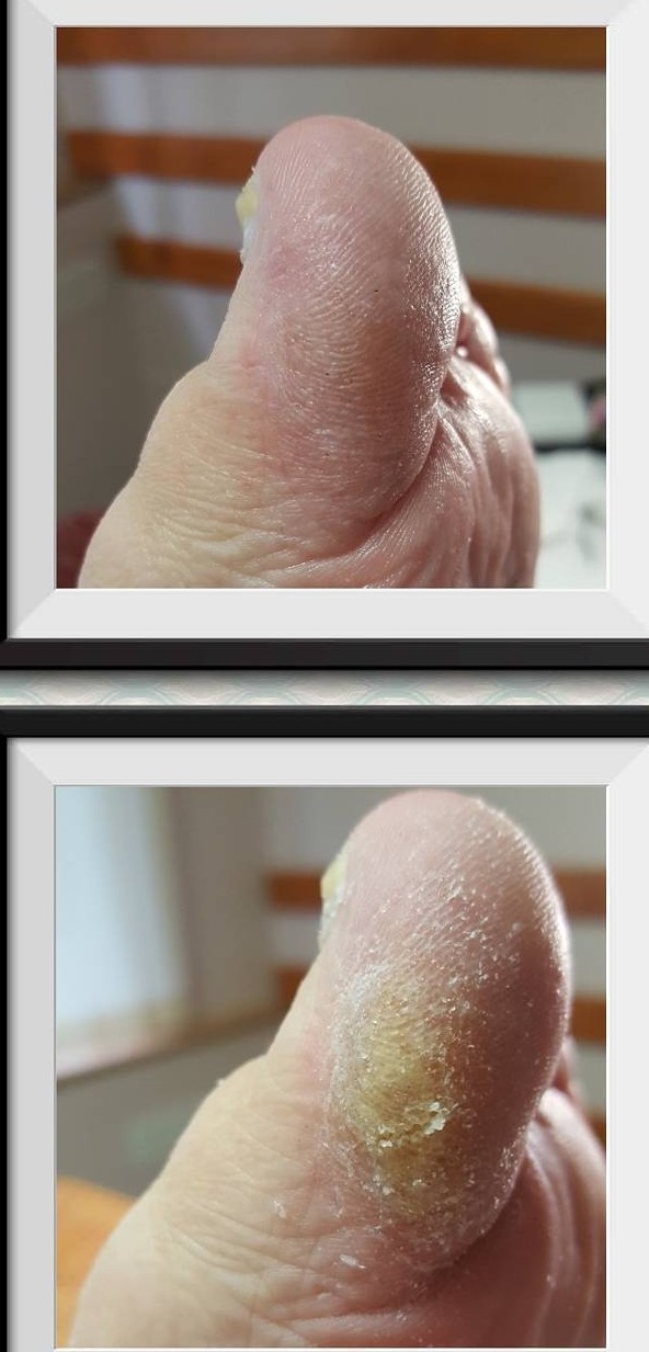 Probleemse pediküüri ravi Tallinnas