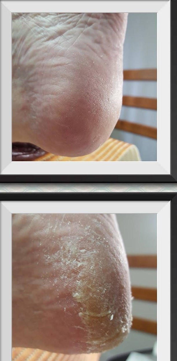 Лечение проблемного педикюра в Таллинне