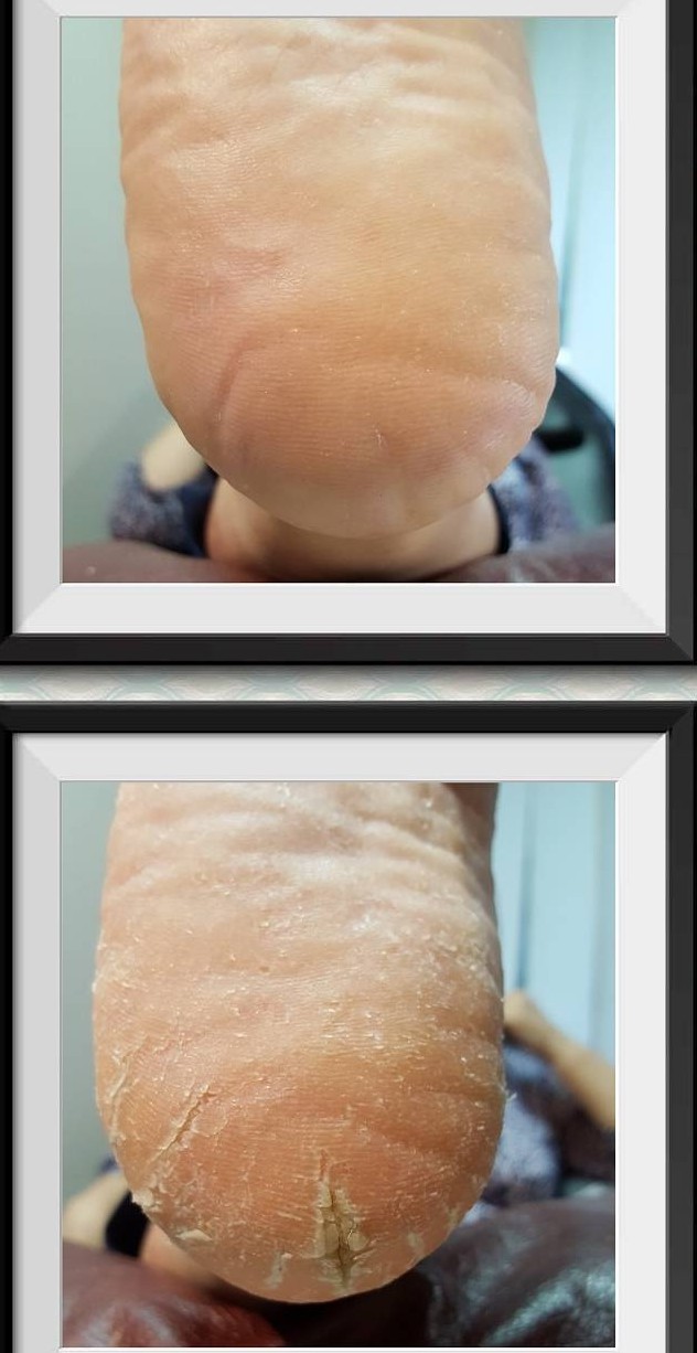 Probleemse pediküüri ravi Tallinnas