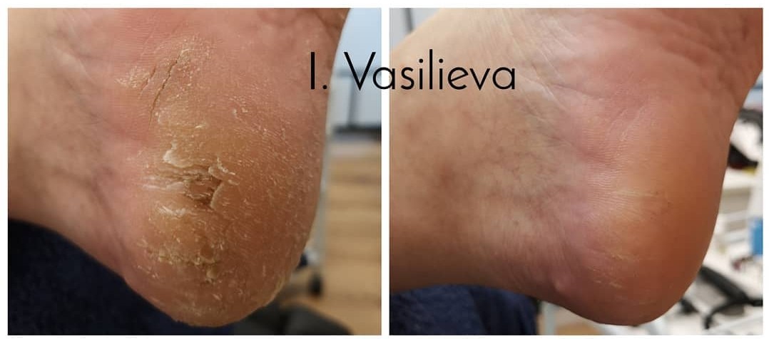 Probleemse pediküüri ravi Tallinnas