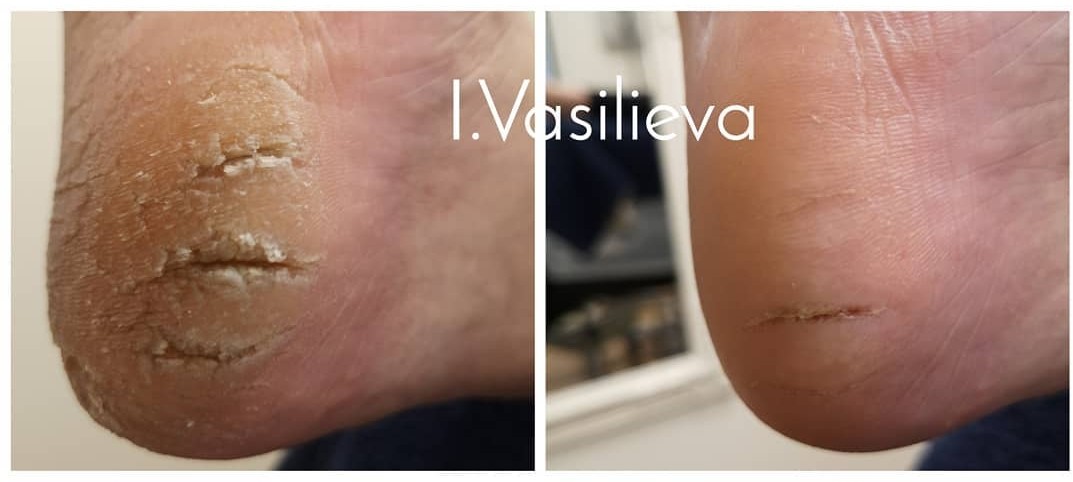 Лечение проблемного педикюра в Таллинне