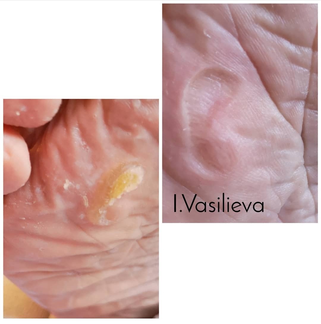 Лечение проблемного педикюра в Таллинне