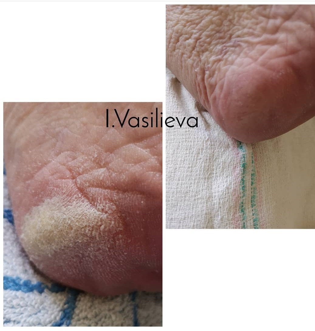 Лечение проблемного педикюра в Таллинне