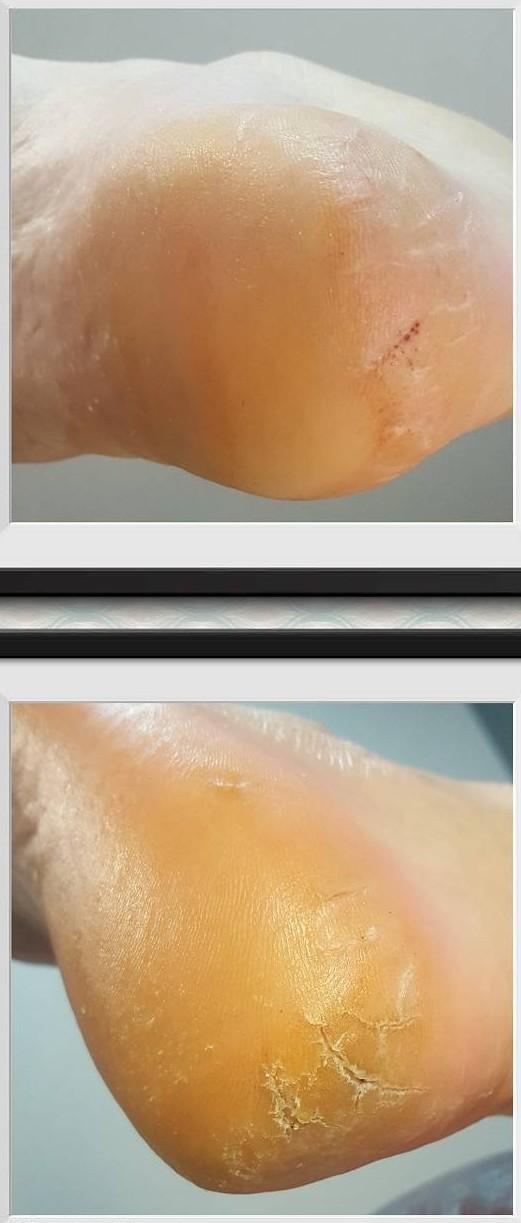 Лечение проблемного педикюра в Таллинне