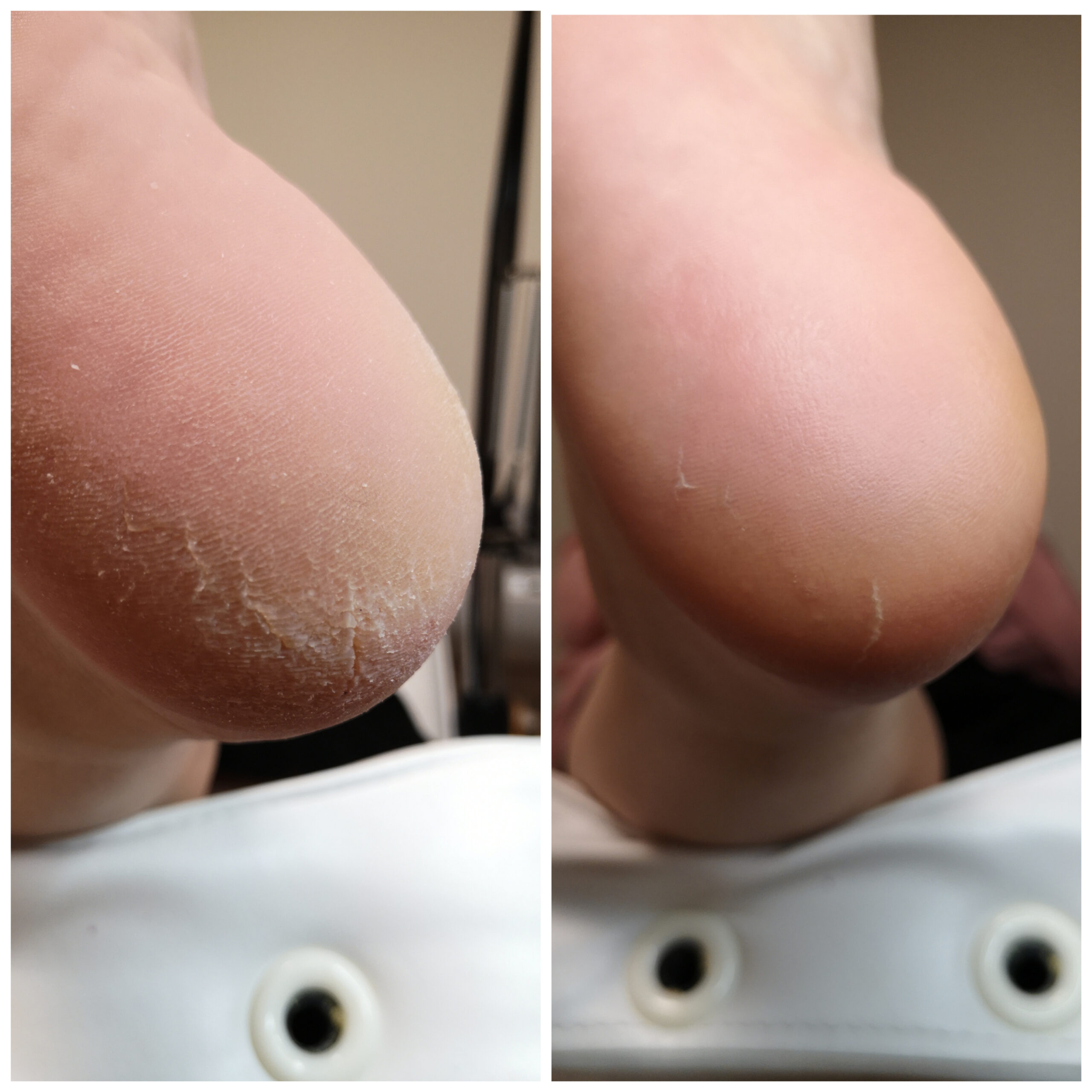 Лечение проблемного педикюра в Таллинне