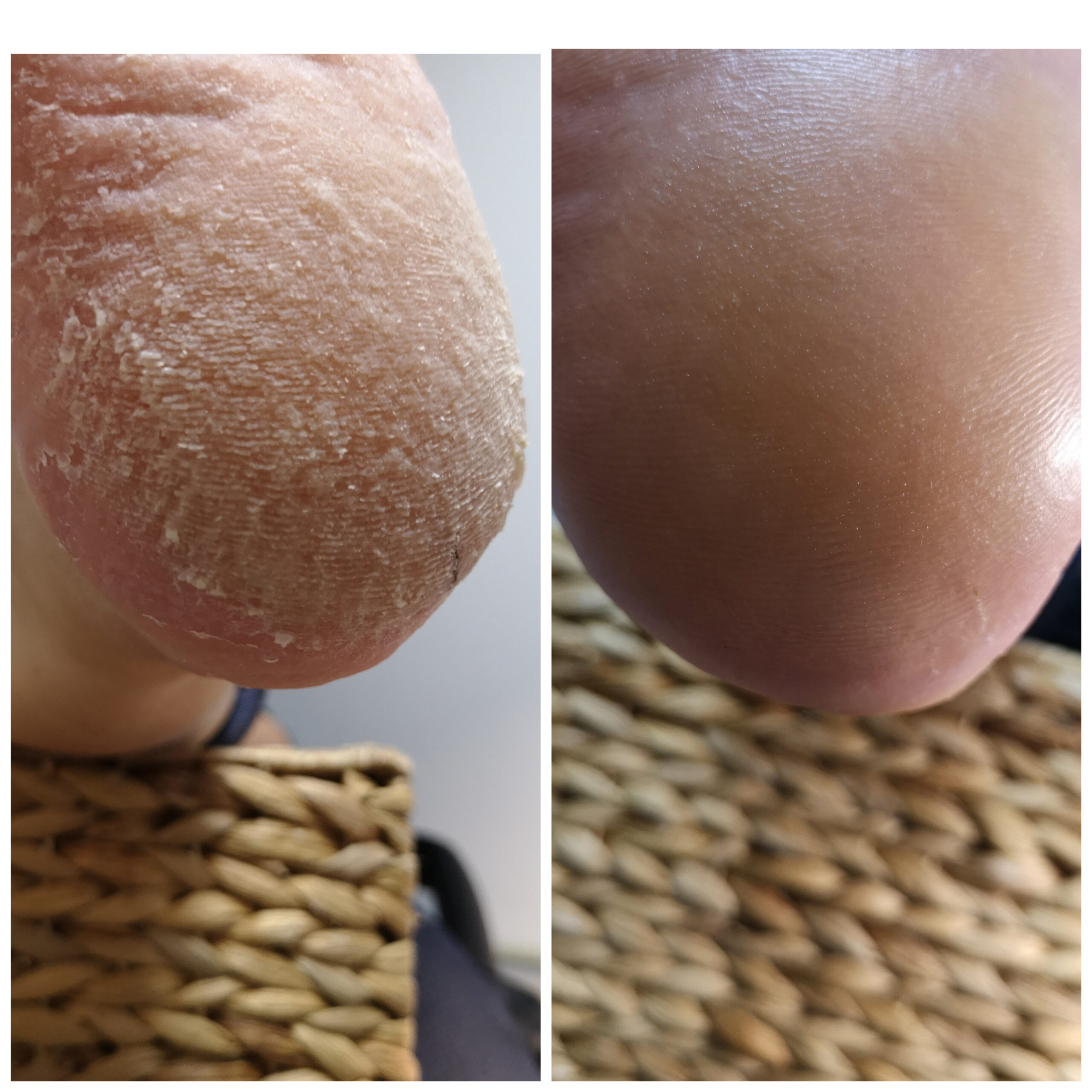 Лечение проблемного педикюра в Таллинне