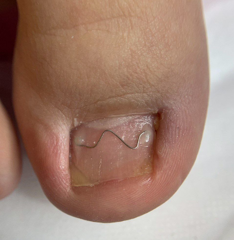 Лечение ногтей титановой нитью